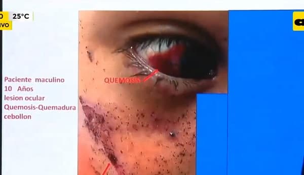 Tendrán que rehacer un pulgar a niño que sufrió explosión de 12×1