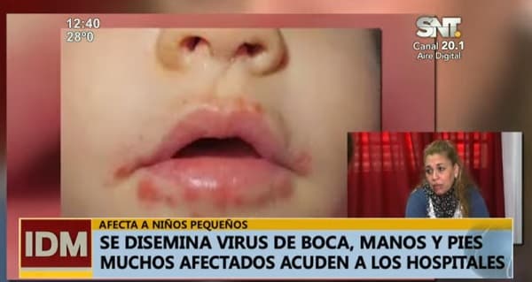 Alertan sobre diseminación del virus de boca, manos y pies en niños