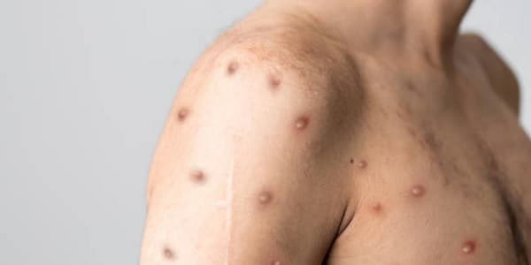 Emiten alerta en Amambay por caso de viruela del mono en Brasil