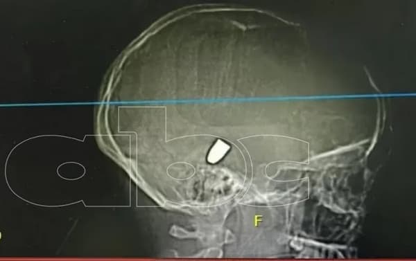 Adolescente está en coma inducido víctima de bala perdida