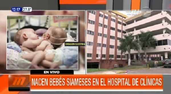 Médicos estudian la posibilidad de separar a los siameses nacidos en Clínicas
