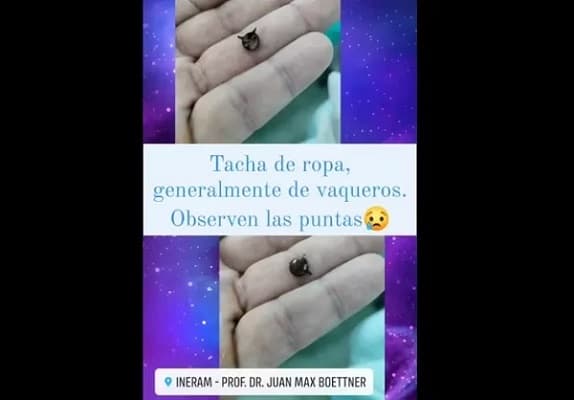 Bebé en Ineram: Extraen tacha de metal de su pulmón