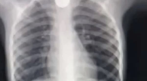 Niño traga moneda de G. 500 y se somete a cirugía