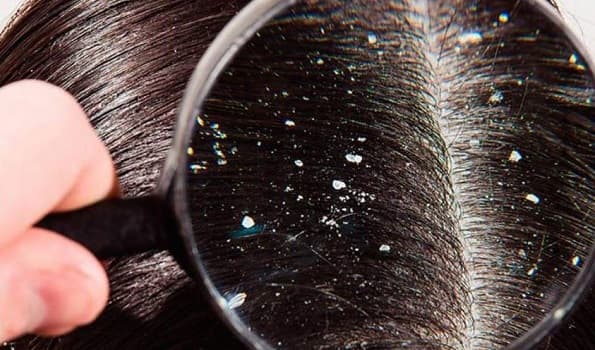 Descubrí cómo eliminar la caspa eficazmente