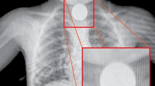 Exitosa intervención salva a niña que ingiere moneda en CDE