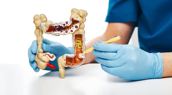 Día Mundial de la Prevención del Cáncer Colorrectal