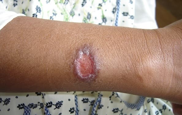 Alerta por incremento de casos de leishmaniasis
