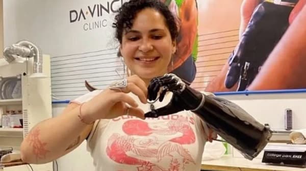 Renata Tiretta prueba innovadora prótesis biónica en Brasil