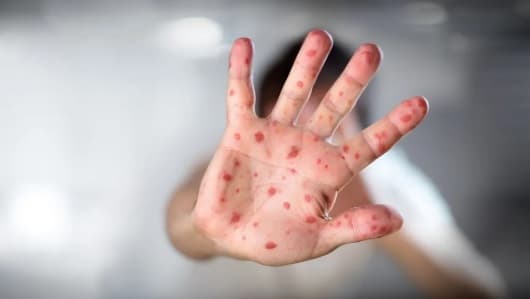 Viruela del mono: Alerta y prevención en Paraguay