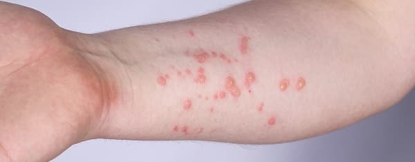 Salud descarta 45 casos sospechosos de viruela del mono