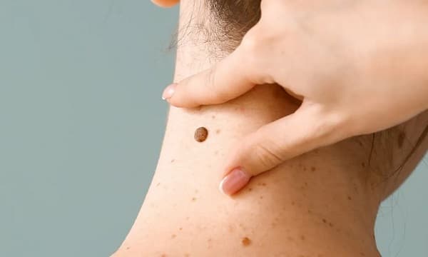 Clínicas ofrece consultas gratuitas para prevenir cáncer de piel