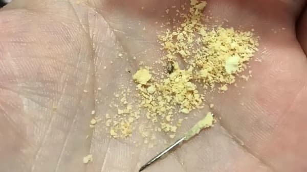 Denuncian aguja en chipita del programa Hambre Cero