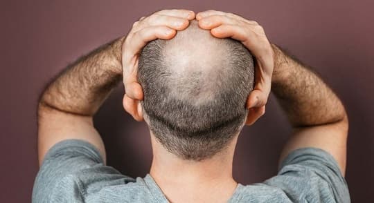 Crema experimental podría revertir la alopecia en pocos años