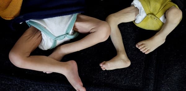 Sube a 82 la cifra de niños muertos por hambre en Gaza