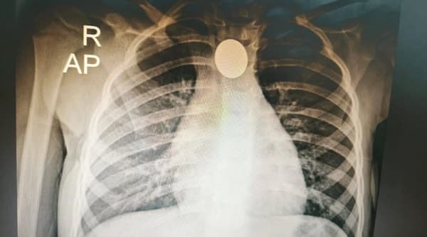 Exitosa extracción de moneda a niña de tres años en Ineram