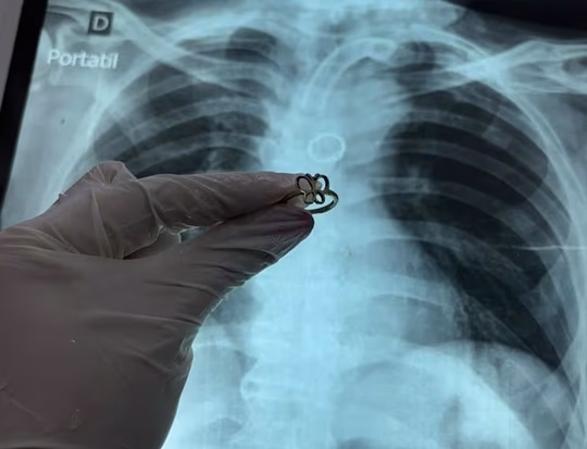 Ineram: extraen anillo de oro del pulmón de paciente